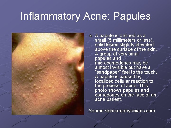 Inflammatory Acne: Papules A papule is defined as a small (5 millimeters or less),