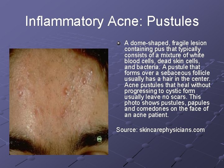 Inflammatory Acne: Pustules A dome-shaped, fragile lesion containing pus that typically consists of a