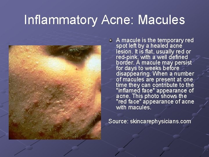 Inflammatory Acne: Macules A macule is the temporary red spot left by a healed