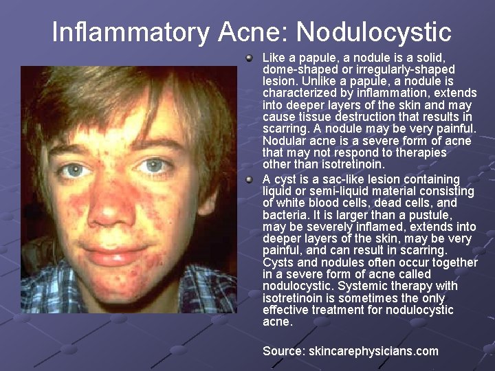 Inflammatory Acne: Nodulocystic Like a papule, a nodule is a solid, dome-shaped or irregularly-shaped