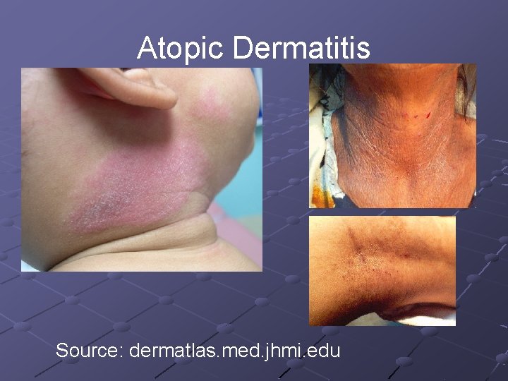 Atopic Dermatitis Source: dermatlas. med. jhmi. edu 