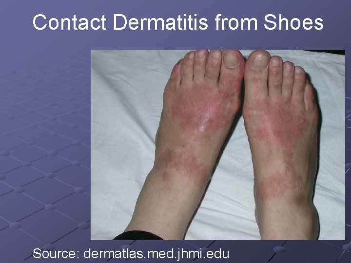 Contact Dermatitis from Shoes Source: dermatlas. med. jhmi. edu 