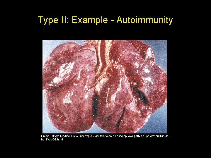 Type II: Example - Autoimmunity From: Dokkyo Medical University http: //www. dokkyomed. ac. jp/dep-k/cli-path/a-super/vasculitis/vashtml/vas-63.