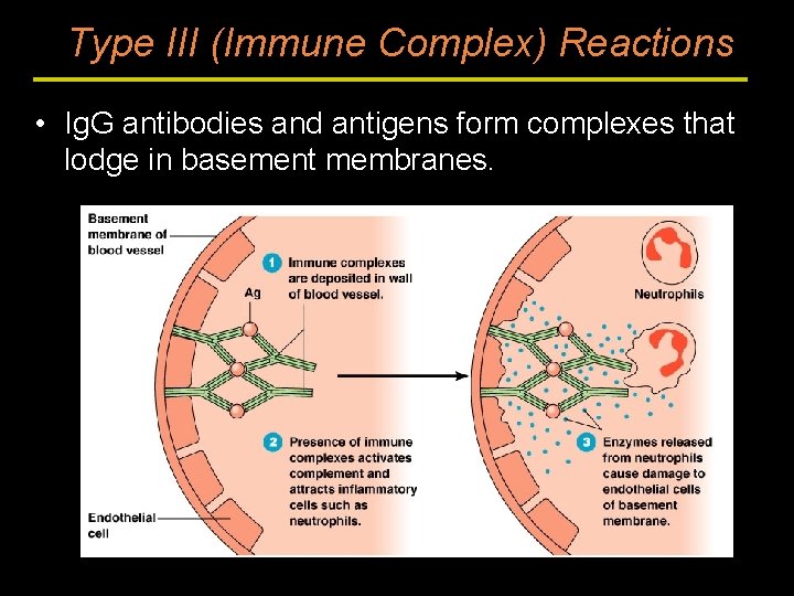 Type III (Immune Complex) Reactions • Ig. G antibodies and antigens form complexes that
