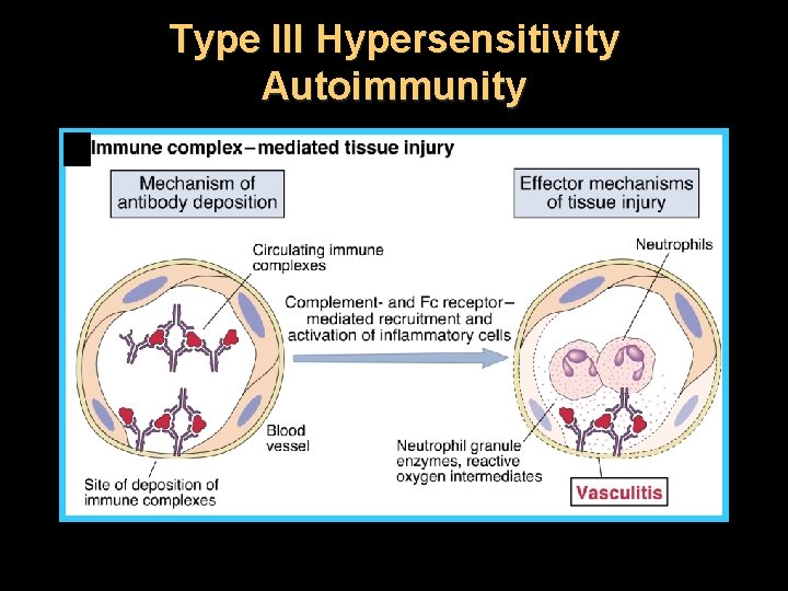 Type III Hypersensitivity Autoimmunity 