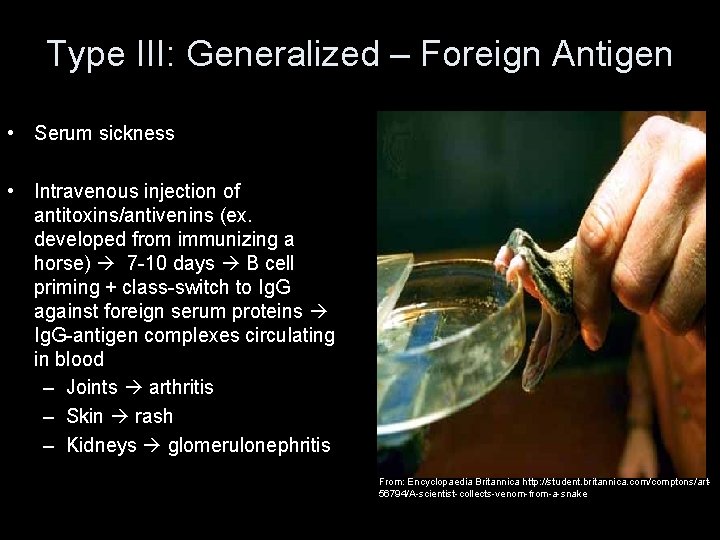 Type III: Generalized – Foreign Antigen • Serum sickness • Intravenous injection of antitoxins/antivenins