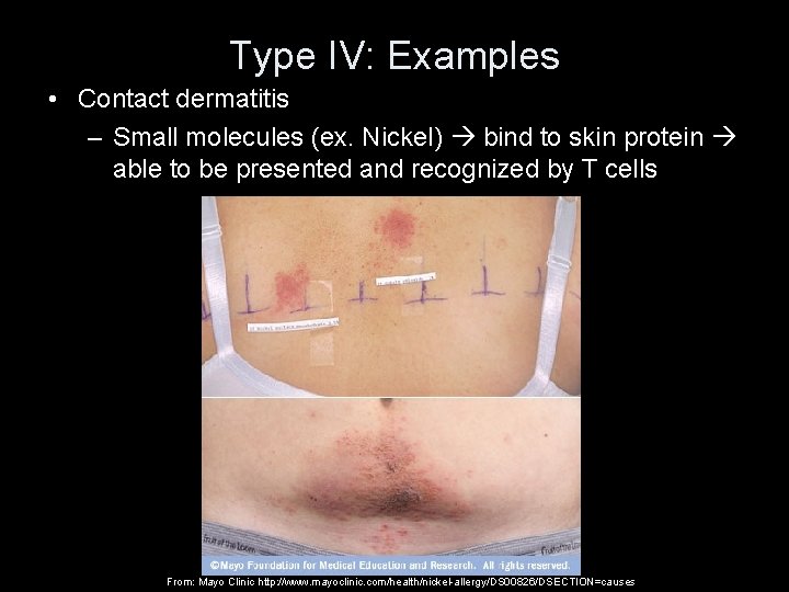 Type IV: Examples • Contact dermatitis – Small molecules (ex. Nickel) bind to skin