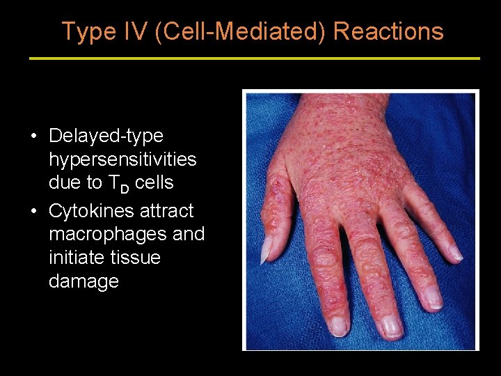 Type IV (Cell-Mediated) Reactions • Delayed-type hypersensitivities due to TD cells • Cytokines attract
