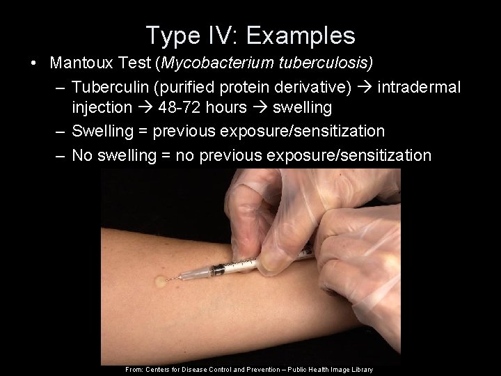 Type IV: Examples • Mantoux Test (Mycobacterium tuberculosis) – Tuberculin (purified protein derivative) intradermal