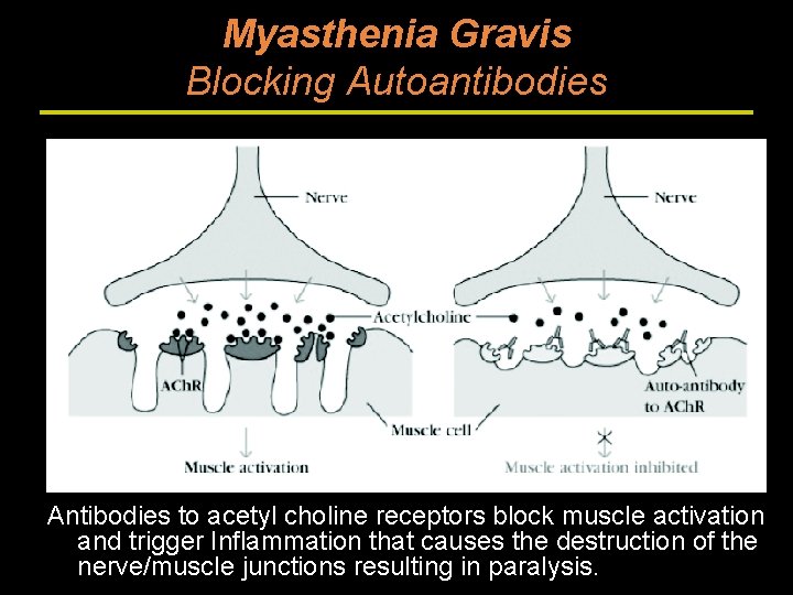 Myasthenia Gravis Blocking Autoantibodies Antibodies to acetyl choline receptors block muscle activation and trigger