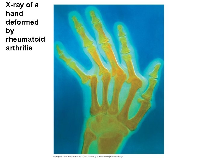 X-ray of a hand deformed by rheumatoid arthritis 