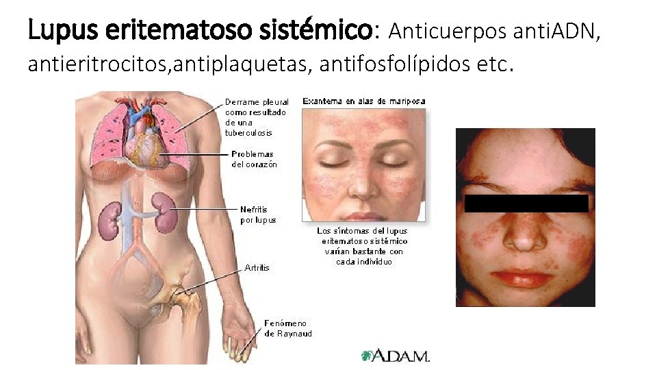 Lupus eritematoso sistémico: Anticuerpos anti. ADN, antieritrocitos, antiplaquetas, antifosfolípidos etc. 