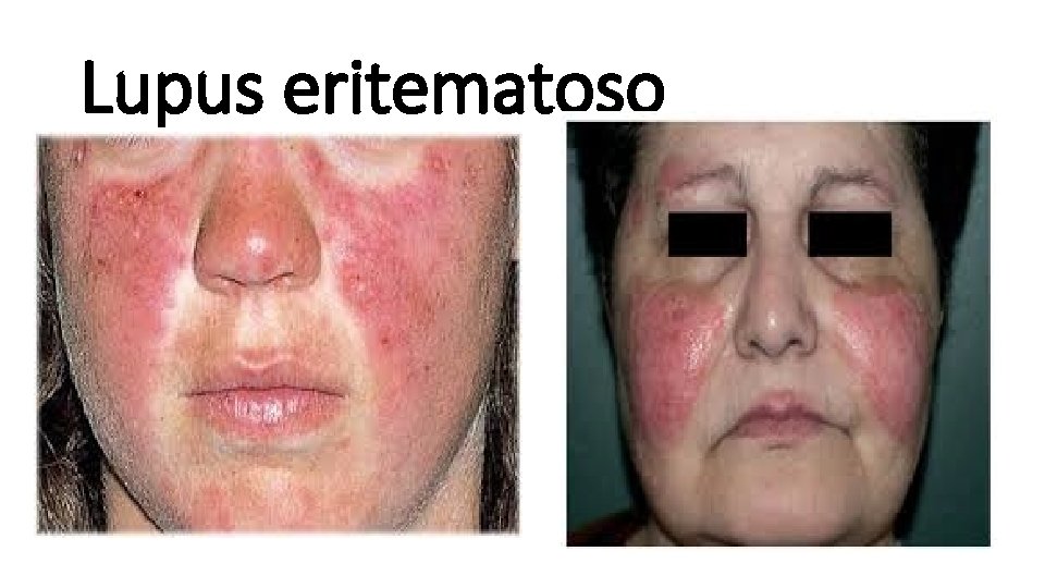 Lupus eritematoso 