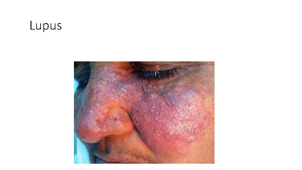 Lupus 