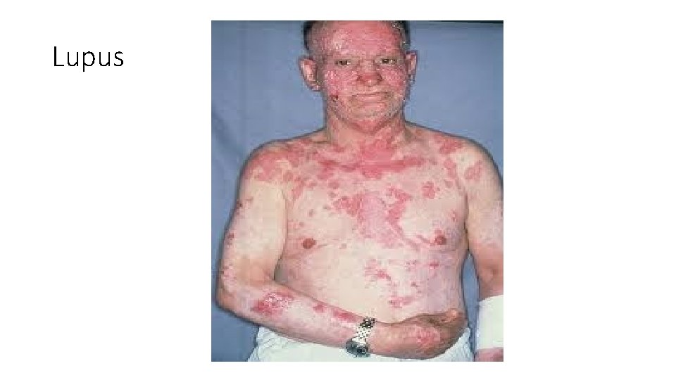 Lupus 