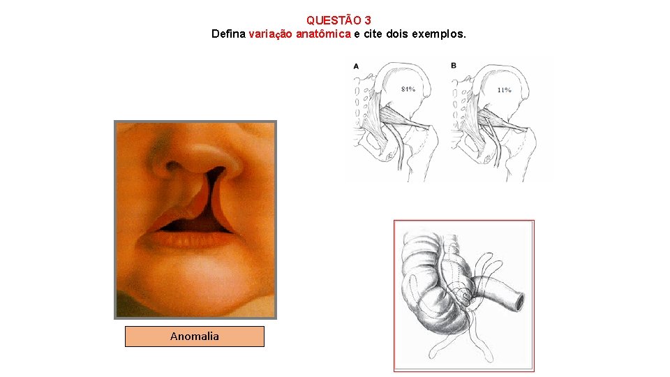 QUESTÃO 3 Defina variação anatômica e cite dois exemplos. Anomalia 