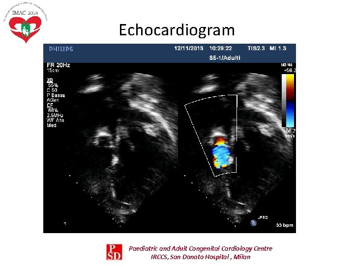 Echocardiogram Paediatric and Adult Congenital Cardiology Centre IRCCS, San Donato Hospital , Milan Echocardiogram Paediatric and Adult Congenital Cardiology Centre IRCCS, San Donato Hospital , Milan