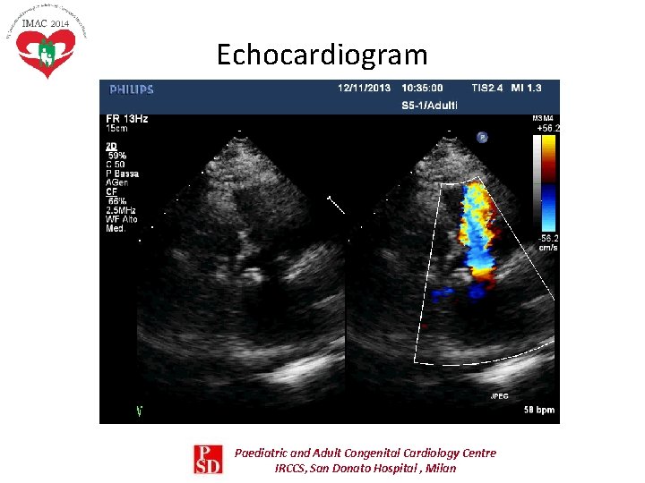 Echocardiogram Paediatric and Adult Congenital Cardiology Centre IRCCS, San Donato Hospital , Milan Echocardiogram Paediatric and Adult Congenital Cardiology Centre IRCCS, San Donato Hospital , Milan