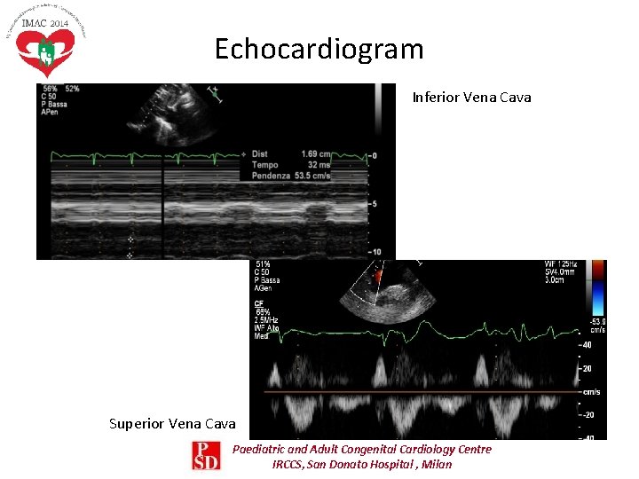 Echocardiogram Inferior Vena Cava Superior Vena Cava Paediatric and Adult Congenital Cardiology Centre IRCCS, Echocardiogram Inferior Vena Cava Superior Vena Cava Paediatric and Adult Congenital Cardiology Centre IRCCS,