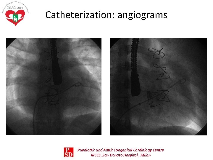 Catheterization: angiograms Paediatric and Adult Congenital Cardiology Centre IRCCS, San Donato Hospital , Milan Catheterization: angiograms Paediatric and Adult Congenital Cardiology Centre IRCCS, San Donato Hospital , Milan