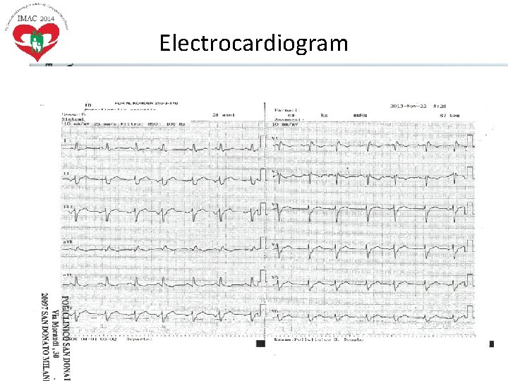 Electrocardiogram • Sinus rhythm, HR 65 bpm. Normal AV conduction. Complete RBBB. Normal repolarisation. Electrocardiogram • Sinus rhythm, HR 65 bpm. Normal AV conduction. Complete RBBB. Normal repolarisation.