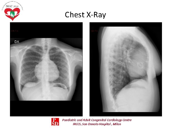 Chest X-Ray Paediatric and Adult Congenital Cardiology Centre IRCCS, San Donato Hospital , Milan Chest X-Ray Paediatric and Adult Congenital Cardiology Centre IRCCS, San Donato Hospital , Milan
