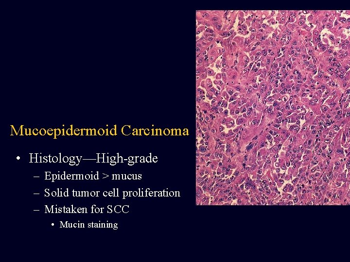 Mucoepidermoid Carcinoma • Histology—High-grade – Epidermoid > mucus – Solid tumor cell proliferation –