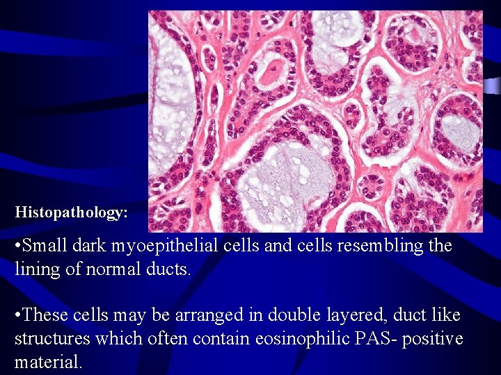 Histopathology: • Small dark myoepithelial cells and cells resembling the lining of normal ducts.