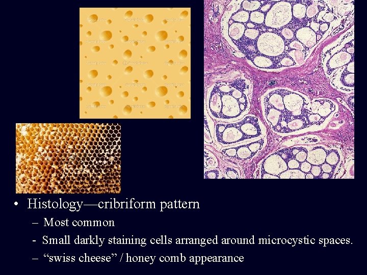  • Histology—cribriform pattern – Most common - Small darkly staining cells arranged around