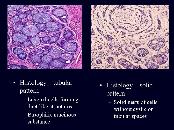  • Histology—tubular pattern – Layered cells forming duct-like structures – Basophilic mucinous substance
