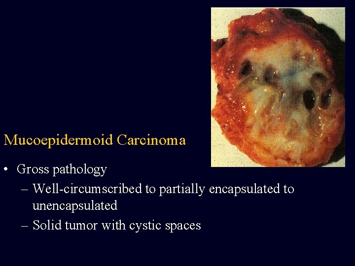 Mucoepidermoid Carcinoma • Gross pathology – Well-circumscribed to partially encapsulated to unencapsulated – Solid