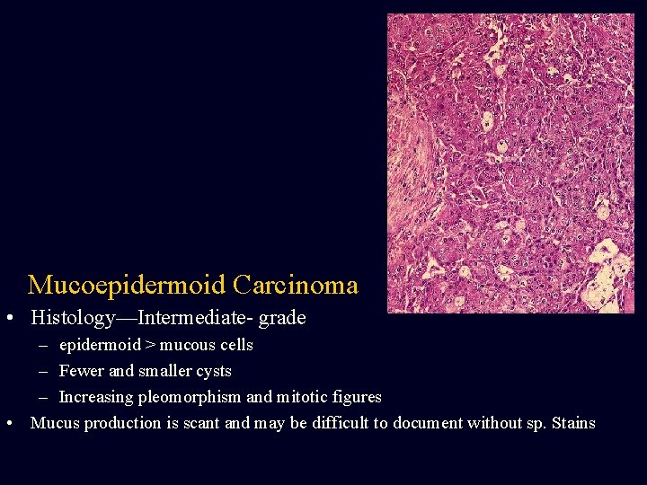 Mucoepidermoid Carcinoma • Histology—Intermediate- grade – epidermoid > mucous cells – Fewer and smaller