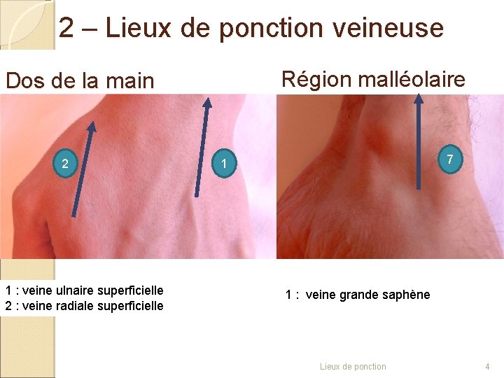 2 – Lieux de ponction veineuse Région malléolaire Dos de la main 2 1