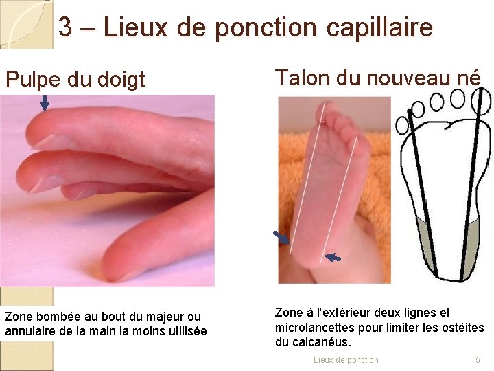3 – Lieux de ponction capillaire Pulpe du doigt Talon du nouveau né Zone