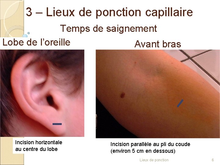 3 – Lieux de ponction capillaire Temps de saignement Lobe de l’oreille Avant bras