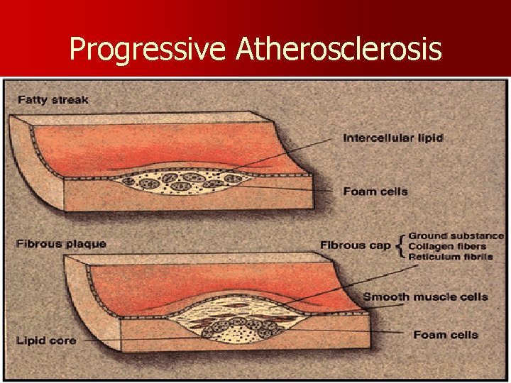 Progressive Atherosclerosis 
