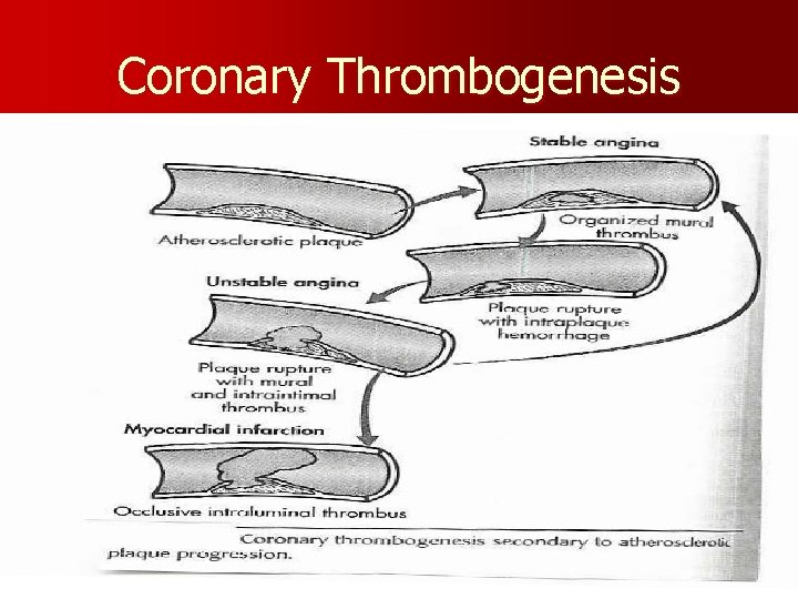 Coronary Thrombogenesis 