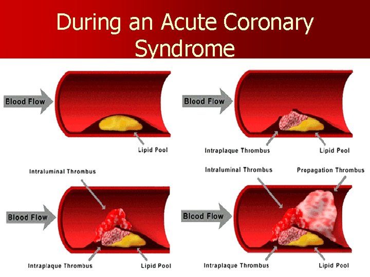 During an Acute Coronary Syndrome 