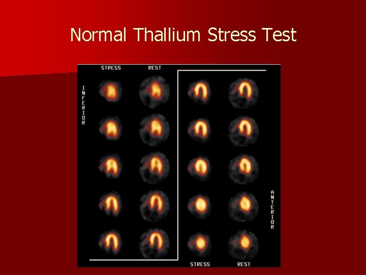 Normal Thallium Stress Test 