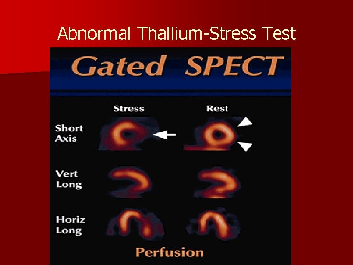 Abnormal Thallium-Stress Test 