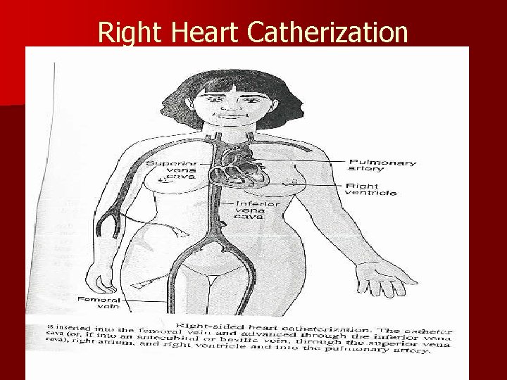 Right Heart Catherization 