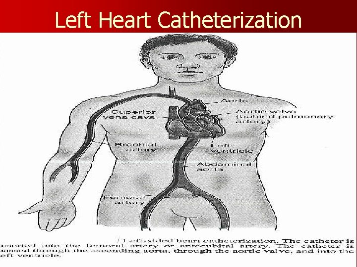 Left Heart Catheterization 