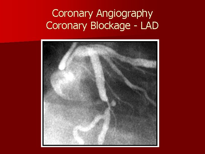 Coronary Angiography Coronary Blockage - LAD 