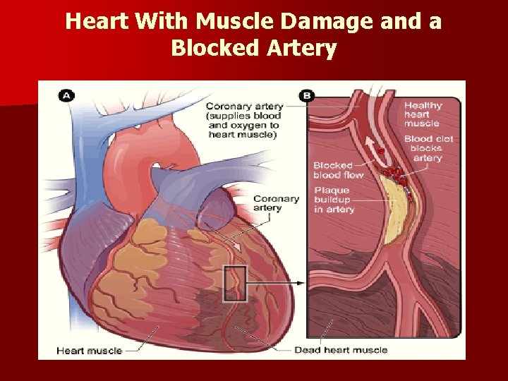 Heart With Muscle Damage and a Blocked Artery 