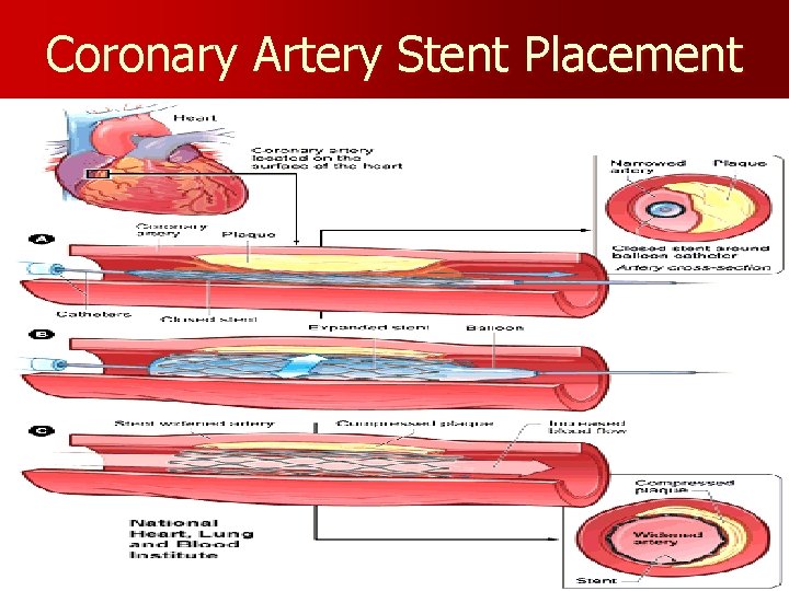 Coronary Artery Stent Placement 