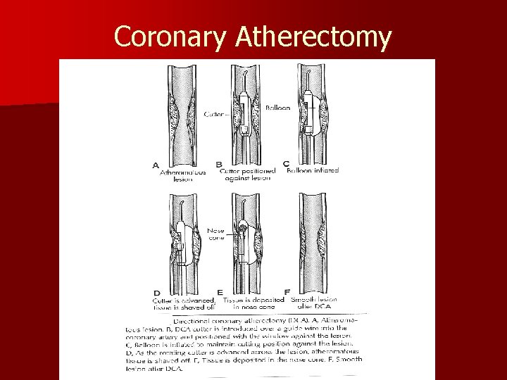 Coronary Atherectomy 