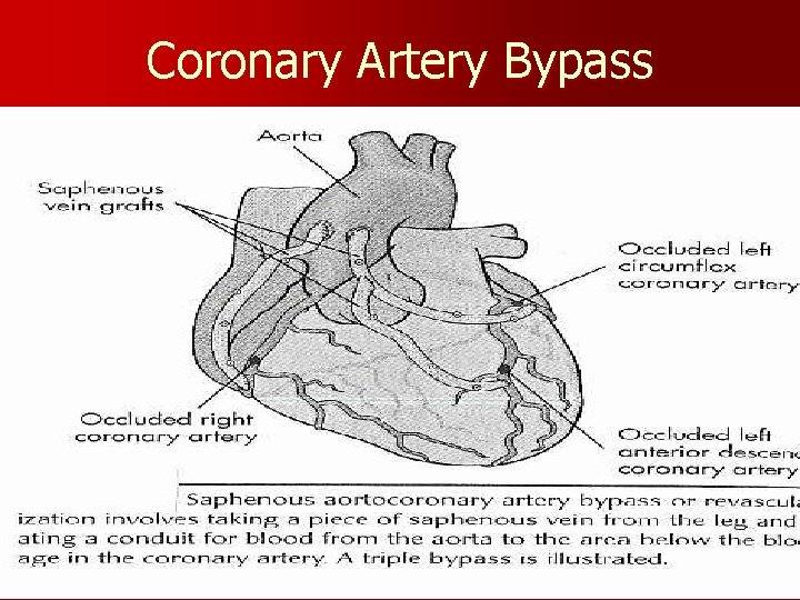 Coronary Artery Bypass 