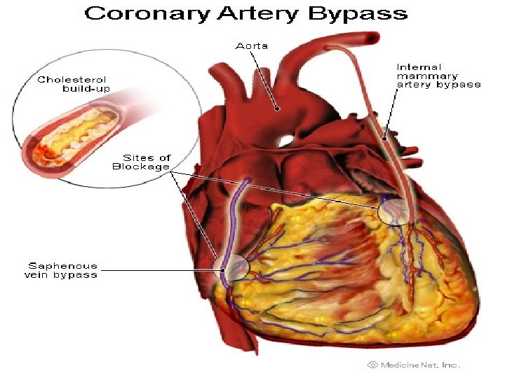 Coronary Artery Bypass 