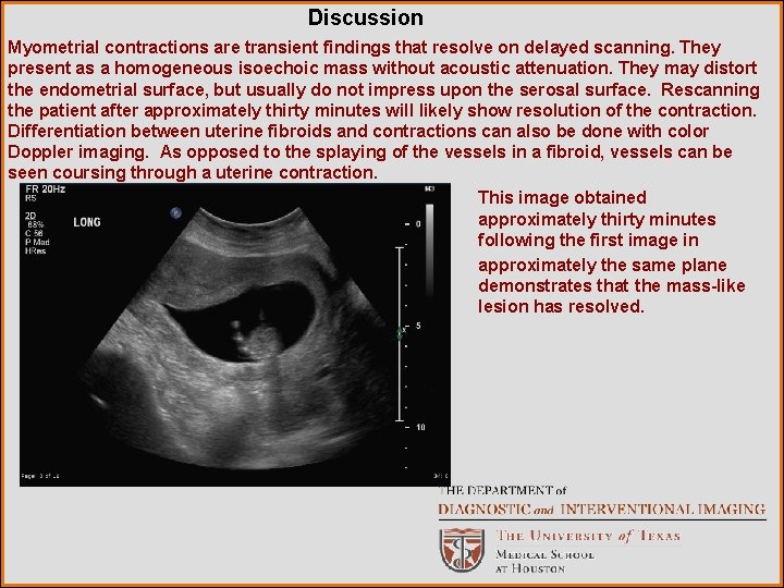 Discussion Myometrial contractions are transient findings that resolve on delayed scanning. They present as