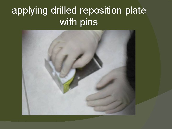 applying drilled reposition plate with pins 
